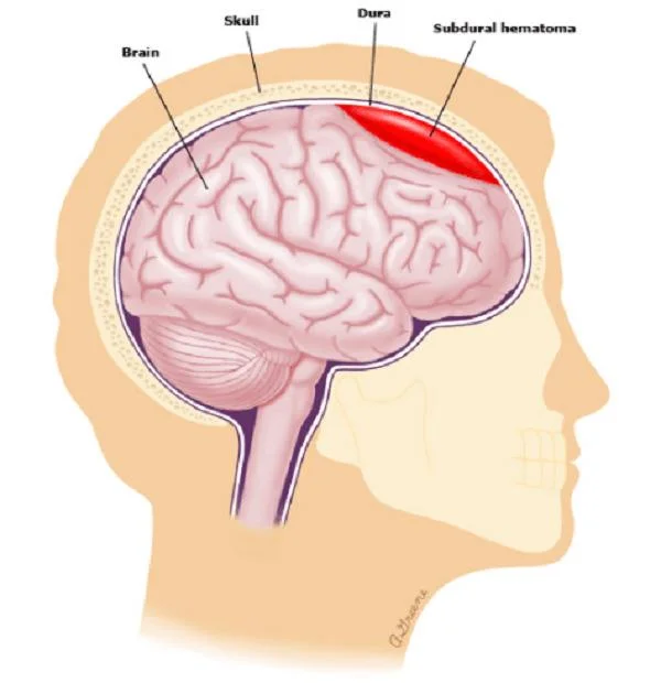 Hefðbundin lyf: Subdural hematoma