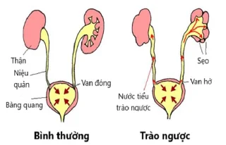 Reflux vesicoureteral: causes, riscos i complicacions