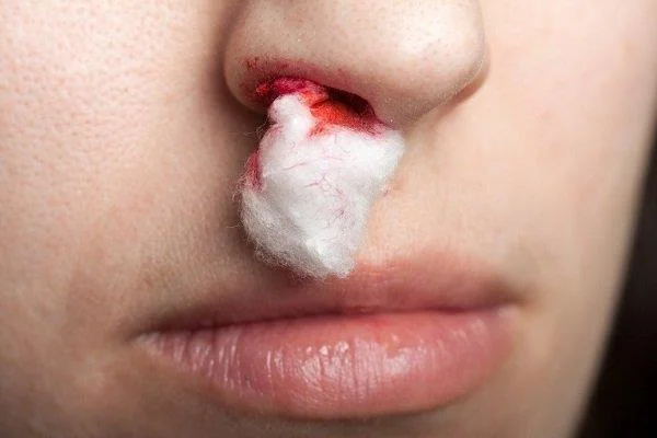 Rinoplastia: todo o que debes saber
