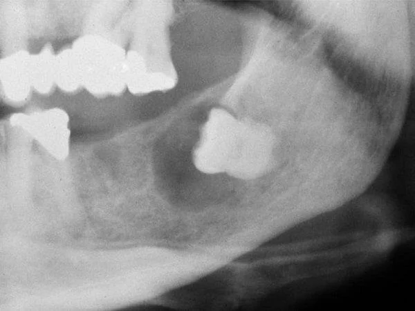 Kronecyster: årsaker, diagnose og behandling
