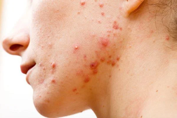 Quines són les causes de l'acne recurrent?