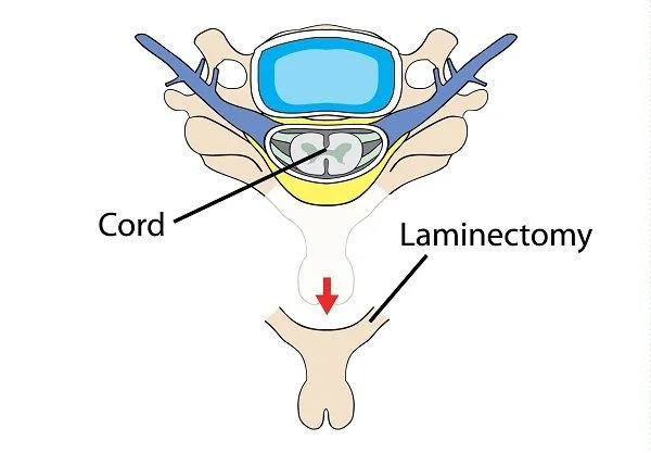 Spinal stenose: diagnose og behandling