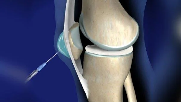 El que necessites saber sobre la bursitis del genoll