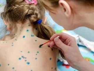 Hvor lenge før man blir gravid bør man vaksinere seg mot vannkopper?
