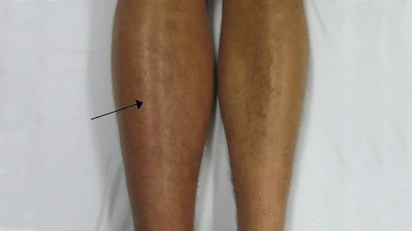 O que debes saber sobre a flebite