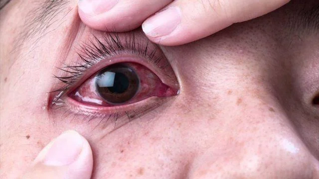 Tracoma: síntomas, causas e tratamento