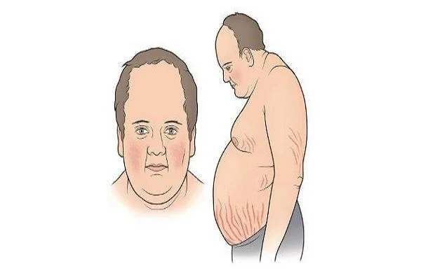 Kušinga sindroms: cēloņi, simptomi un ārstēšana