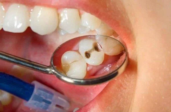 Que é a caries?  Causas, tratamento e prevención