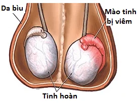 Ali lahko orhitis povzroči neplodnost?