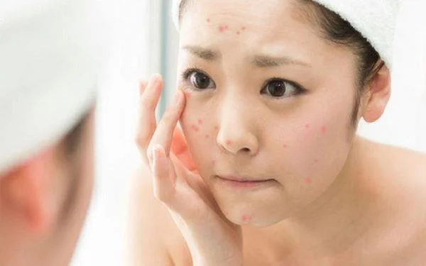 Quines són les causes de l'acne recurrent?