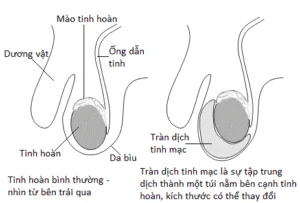 Hydrocele hos barn