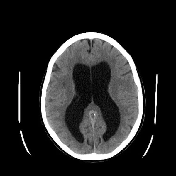 Konvensjonell medisin: Hydrocephalus