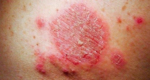 Matallergier: hva du trenger å vite og hvordan du kan forhindre det