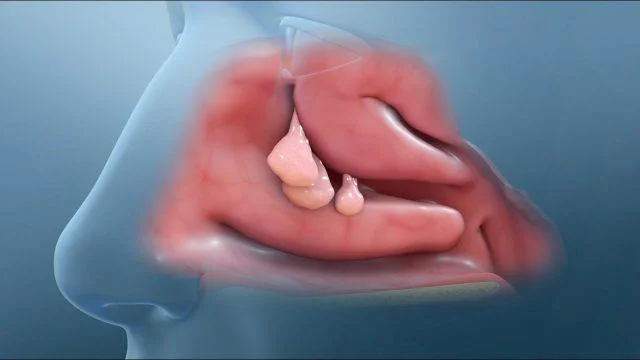 Pólipos nasais: cales son os tratamentos?  Cando necesito unha cirurxía?