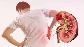 Còlic renal: un dolor que no es pot ignorar