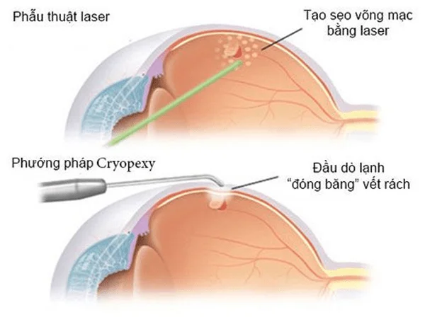 Estrutura da retina e enfermidades comúns da retina