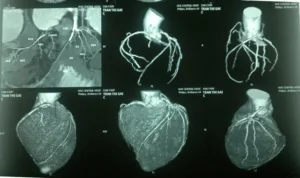 Koronar angiografi: Är det farligt?