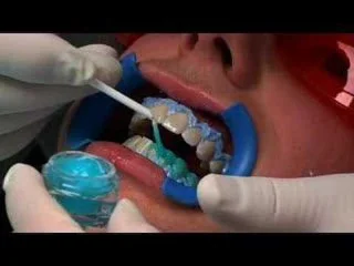 Branqueamento dos dentes e métodos populares hoxe