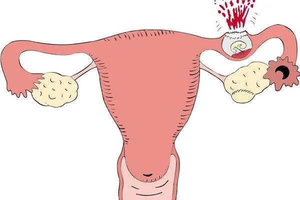 Dolor abdominal, a què s'ha de parar atenció per no perdre's causes perilloses?
