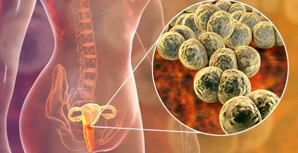 Enfermidade inflamatoria pélvica (EIP): unha enfermidade con complicacións imprevisibles