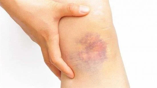 Hematomas pouco comúns advirten de enfermidades perigosas que debes saber!