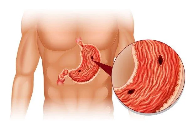 Dolor abdominal, a què s'ha de parar atenció per no perdre's causes perilloses?