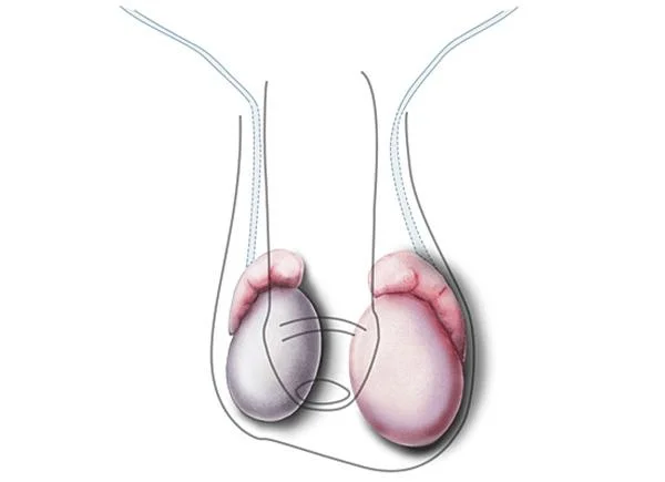 Malalties testiculars de les quals els homes han de tenir cura
