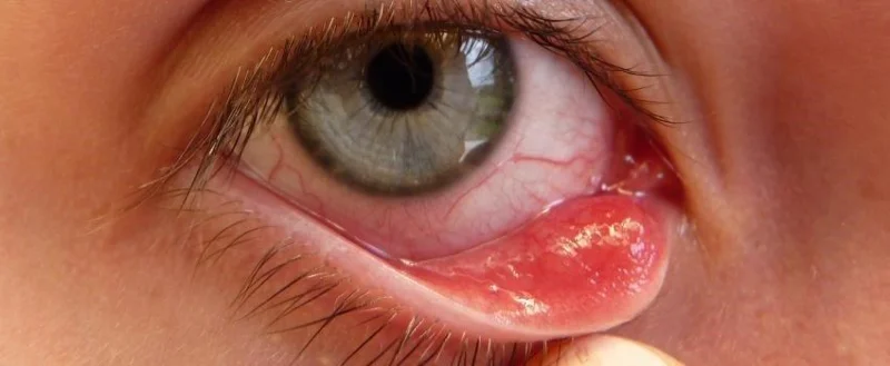 Ulls inflats: què cal saber i com prevenir-ho