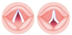 Laryngitis: Årsager, symptomer og behandling