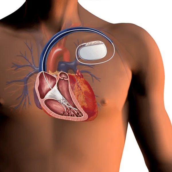 Miocardiopatía hipertrófica: causas, síntomas e tratamento