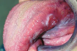 Cancro bucal: o perigo vén dos hábitos cotiáns