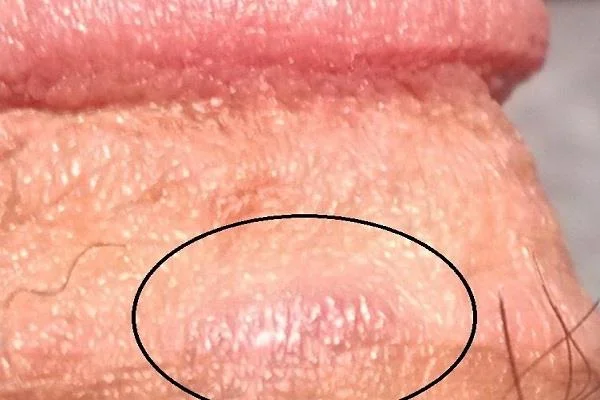 Hvordan takle en illeluktende penis?