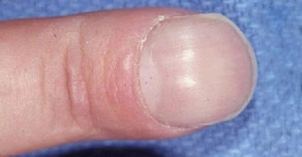 Síndrome hepatopulmonar: definició, signes, diagnòstic i tractament