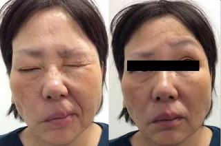 Ramsay Hunt syndrom: symptomer, diagnose og behandling