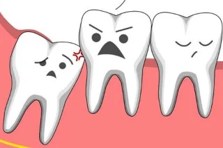 Métodos de alivio da dor e da dor dos dentes do xuízo que debes coñecer