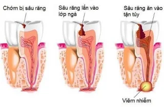 Inflamación da pulpa dental: causas, diagnóstico e tratamento