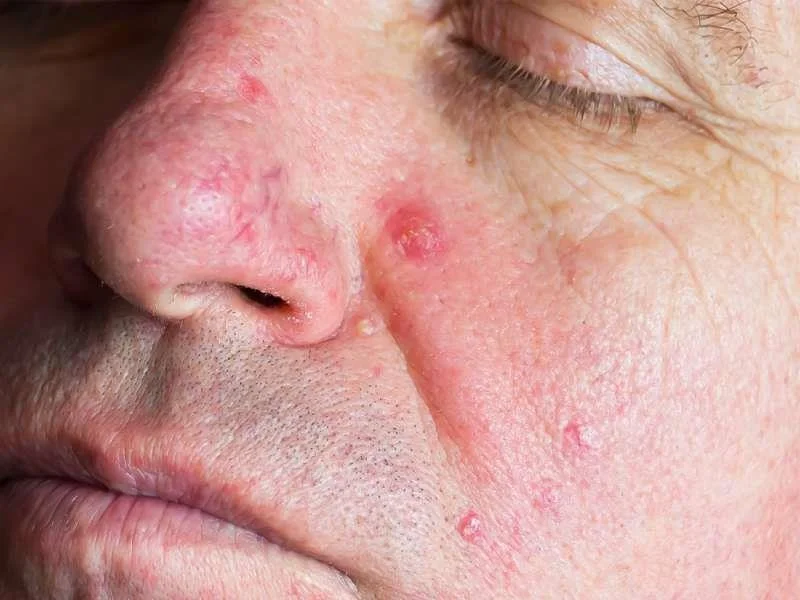 Dermatite Demodex en humanos e o que debes saber