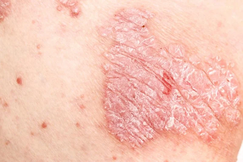 Psoriasis: Orsakir, einkenni, meðferð