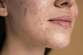 É bo espremer o acne? Consecuencias graves ao espremer o acne de forma incorrecta