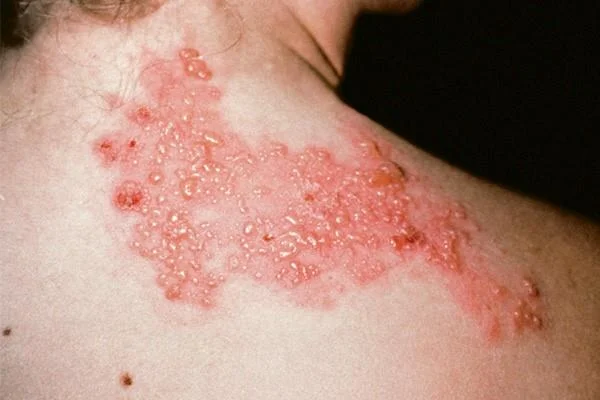 Juostinė pūslelinė: priežastys, simptomai ir diagnozė