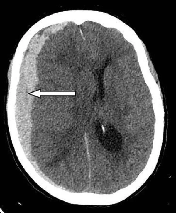 Hefðbundin lyf: Subdural hematoma