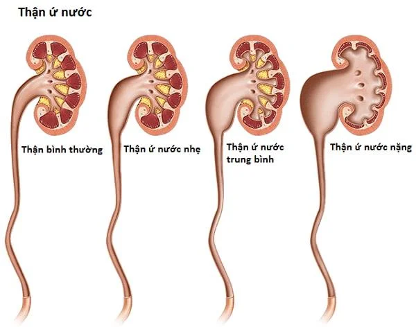 Que é a obstrución ureteral e como che molesta?