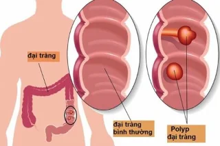 Pólipos de colon: cantas veces hai que repetir a colonoscopia?