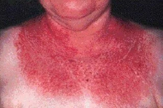 Dermatomiosite: enfermidade autoinmune rara que debes coñecer