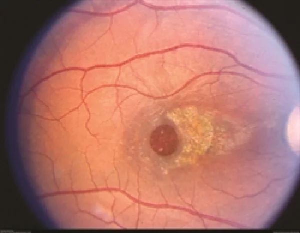 Estrutura da retina e enfermidades comúns da retina