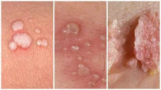 Könsvårtor test för att diagnostisera sjukdomen du bör känna till