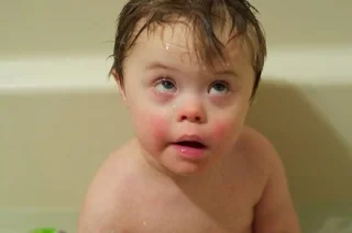 Hvad er Downs syndrom?