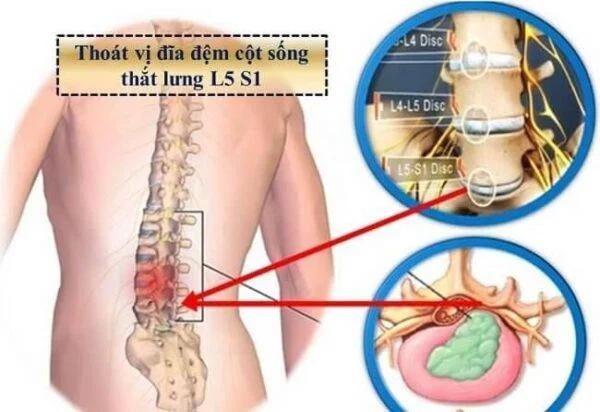 Tradisjonelle medisinleger svarer om metoden for akupressur for herniated discs