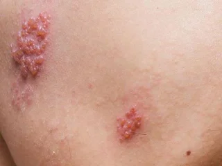 Helvedesild: Årsager, symptomer og diagnose