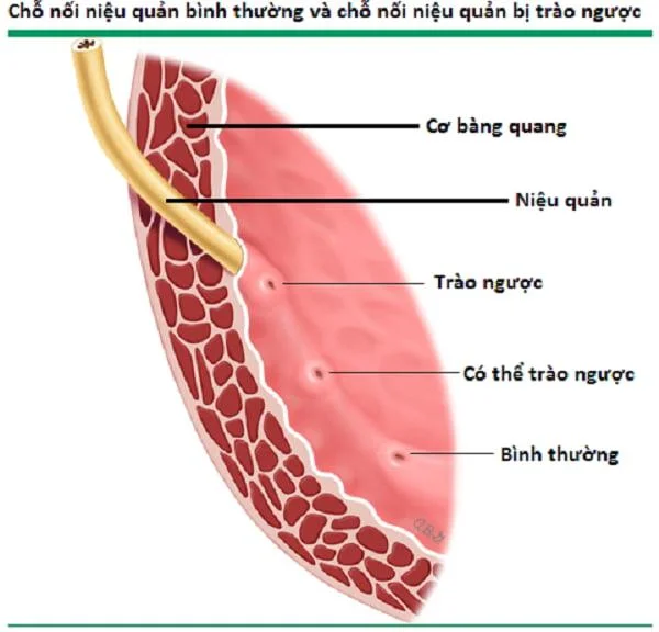 Que é a obstrución ureteral e como che molesta?